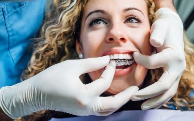 Why You Should Choose an Orthodontist Over Mail-Order Aligners