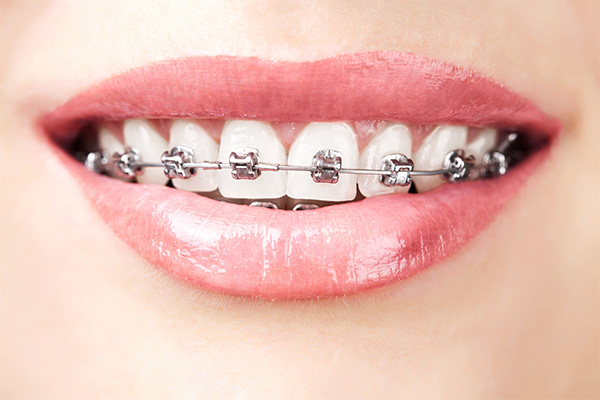 How much do braces cost