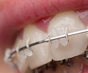 Ceramic Braces at Walton & Maready Orthodontics