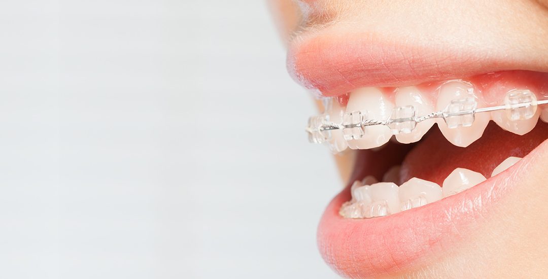 Common Orthodontic Treatment