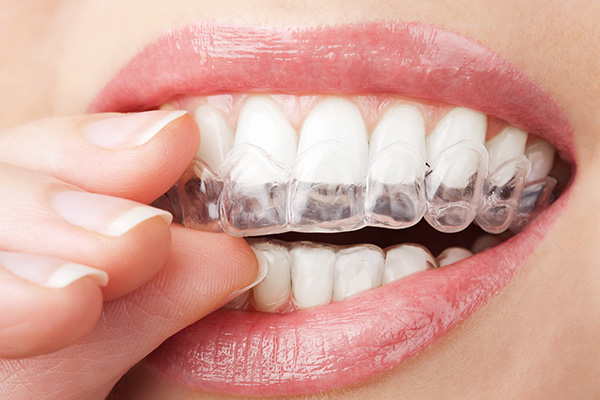 How much does Invisalign cost