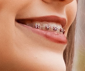 traditional-braces